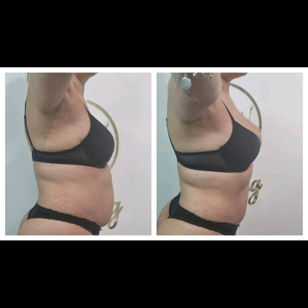 lipo-cavitation treatment result